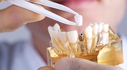 dentist placing a crown on a dental implant
