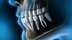 X-ray of a patient with dental implants in State College