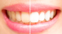 before-and-after teeth whitening results