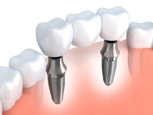 Good support, natural chewing, and youthful looks are benefits of dentures held by dental implants in State College. Learn details from Dr. Chris Devlin.