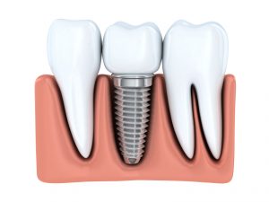 Learn about the benefits of getting a dental implant in State College over other treatments.