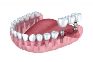 digital image of dental implants