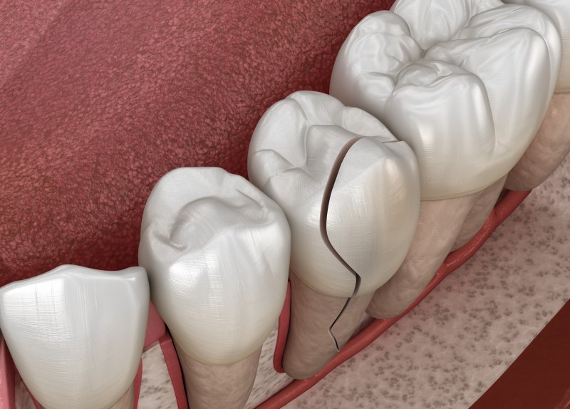 A 3D illustration of a cracked tooth, which is a common dental emergency for athletes